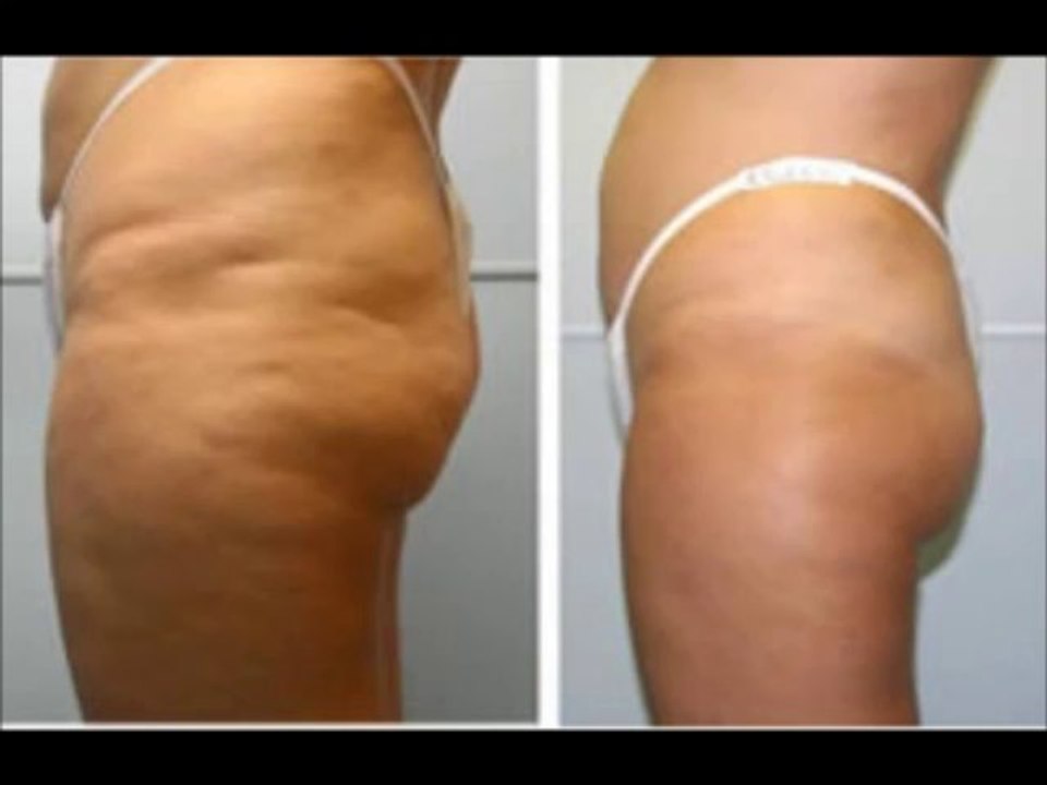 Celulitis Nunca Mas... Sepa sus causas y como eliminarlas naturalmente  100% efectivo 