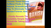 Getting Rid Of Tonsil Stones | Banish Tonsil Stones