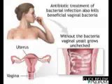 cure male yeast infection Natural Cure for Yeast Infection.mp4.avi cure male yeast infection