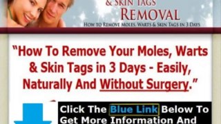 Moles Warts Removal Review + Moles Warts & Skin Tags Removal Pdf