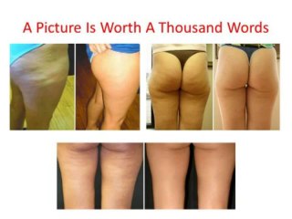 Cellulite Cure - The Official Cellulite Cure
