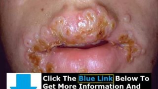 How You Get Rid Of Herpes + How To Get Rid Of Herpes Pain