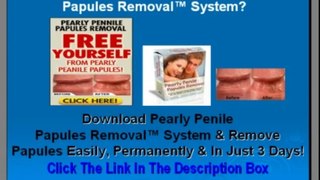 Pearly Penile Papules Removal Review - DO NOT BUY This Product Until You Watch This Video!