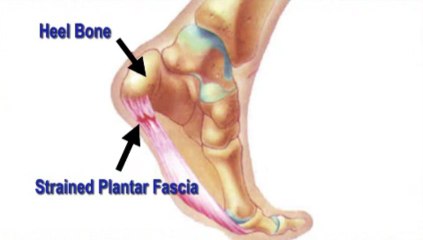 Podiatrist - Heel Pain - Palm Harbor and Tarpon Springs, FL