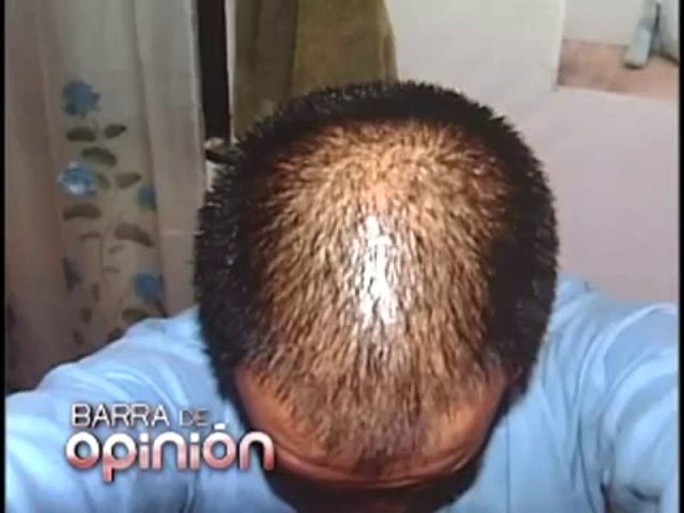 Alopecia y su devastador impacto psicologico