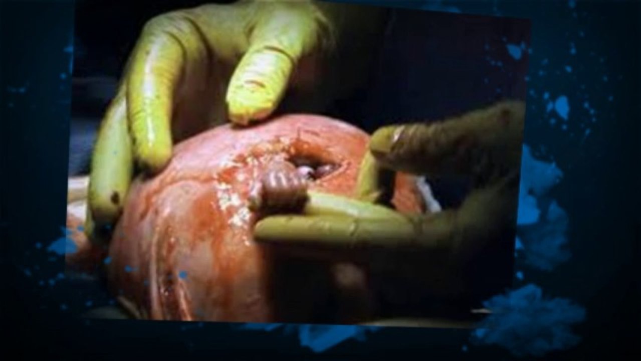 surgical pregnancy termination
