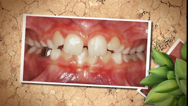 Colorado Springs Braces July2013