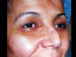 rhinoplastie secondaire(rhinoplasty revision)avant après ,by vladimlir mitz