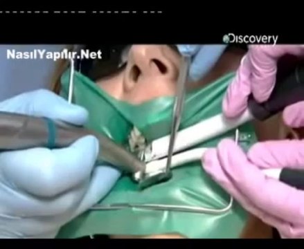 Diş Dolgusu Nasıl Yapılır_ _ NasılYapılır.Net _