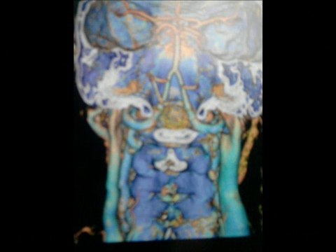 Acoso Laboral &Suicidios