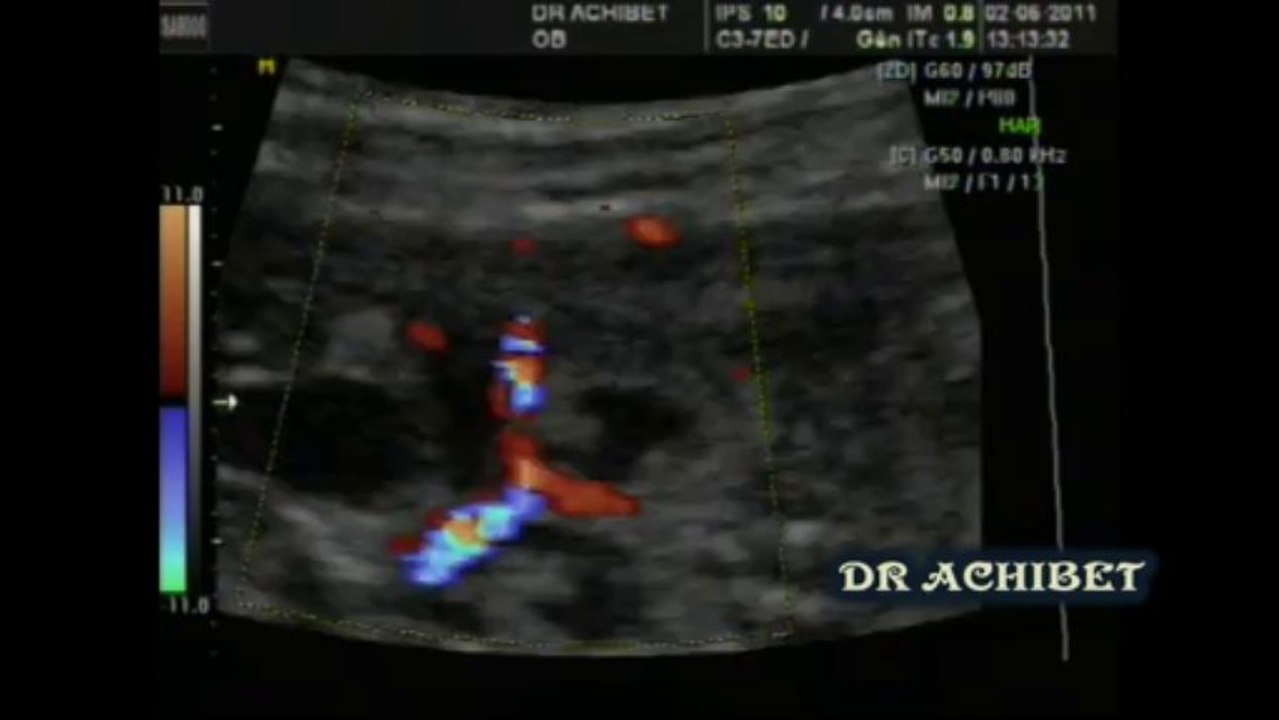 VALVES URETRE  POST