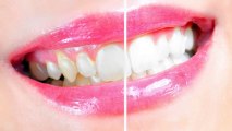 Cosmetic Dentist Manassas Park - Dental Implants, Sedation Dentistry, Veneers