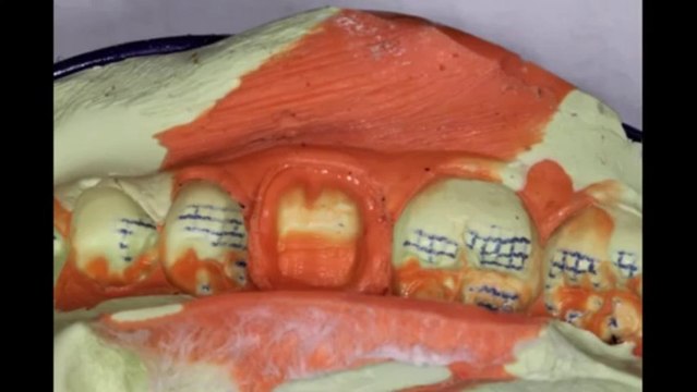 Thay thế răng sâu, răng bể bằng răng sứ - nha khoa Đại Việt