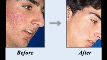 Get help with your acne problems - Natural treatment for acne - Acne no more!
