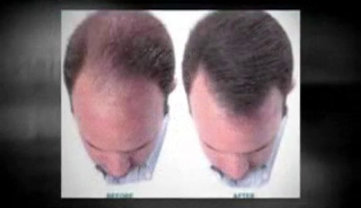 Hair Regrowth