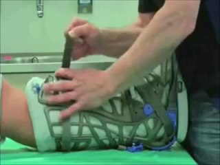 Fratture malleolari senza gesso