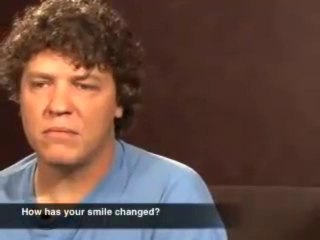 Invisalign Chicago, John J. Kelly DDS - Veneer Patient