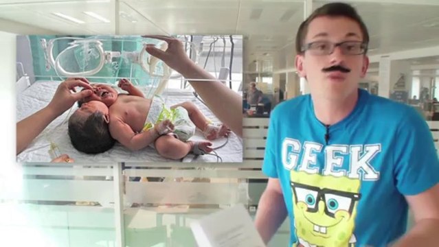 Une fillette née avec deux têtes