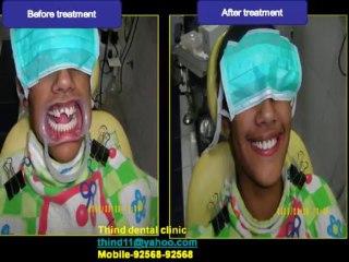 cosmetic fillings