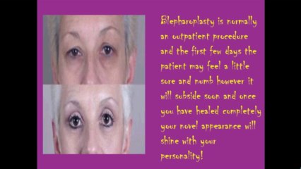 Look a decade young with eyelid surgery