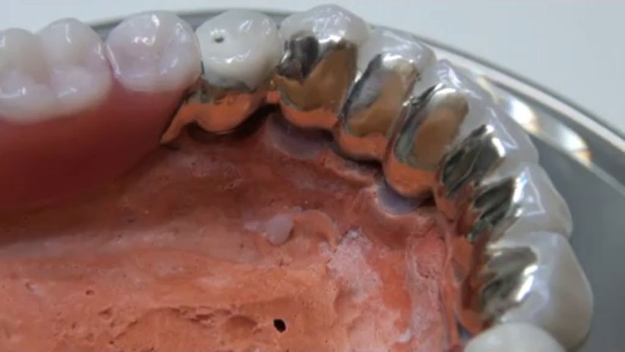 Teleskopprothesen - herausnehmbare gaumenfreie zahnbrücken