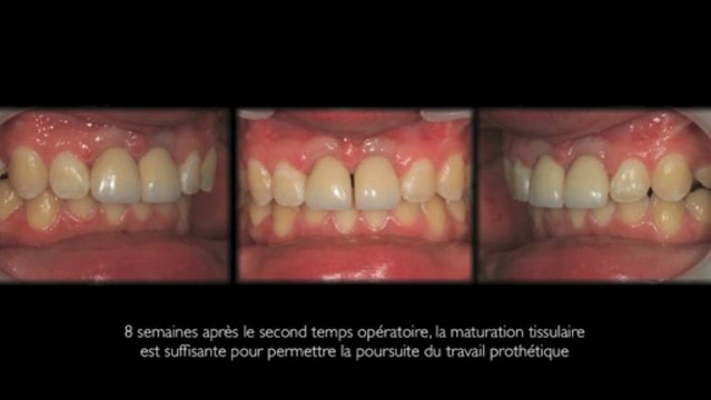 Implants dentaires/Dental Implants: Incisives centrales/Central Incisors