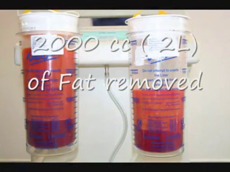 Liposuction