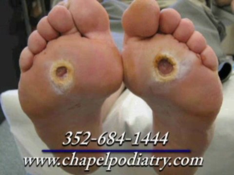 Treatment for Diabetic Feet - Spring Hill, Homosassa, Brooksville, FL - Charles Chapel DPM Podiatrist