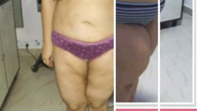 Get Best Solutions for Breast Surgery in Delhi NCR, Weight Loss Surgeries