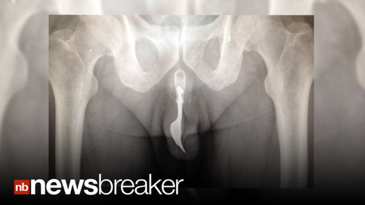 SHOCKING X-RAY: Man has Fork Removed from Penis After Sex Gone Wrong