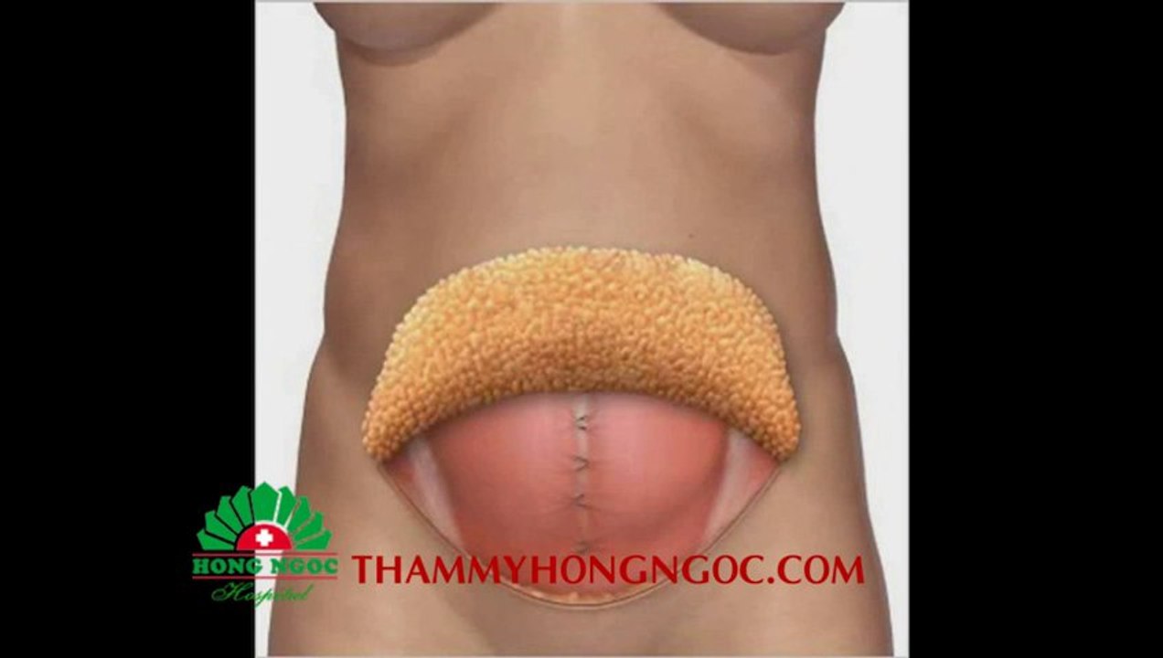 Căng da bụng | Cang da bung