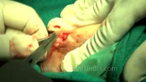 Surgery of Fibroid in Breast-hdv-fx-1-01-27