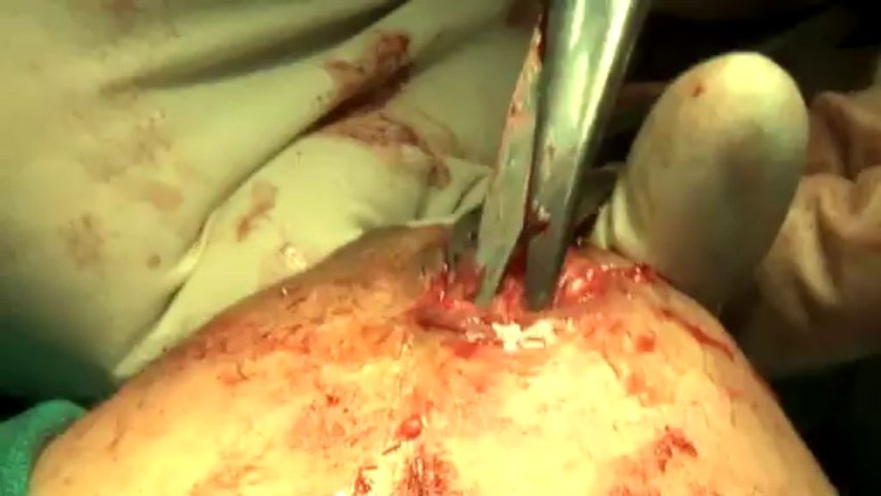 Surgery of Fibroid in Breast-hdv-fx-1-01-35