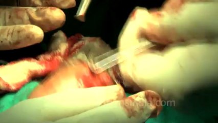 Surgery of Fibroid in Breast-hdv-fx-1-01-39