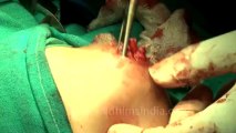 Surgery of Fibroid in Breast-hdv-fx-1-01-48
