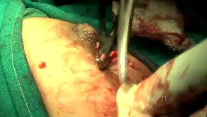 Surgery of Fibroid in Breast-hdv-fx-1-01-49
