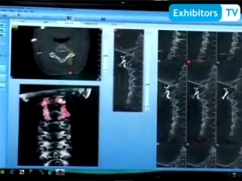 NewTom Cone Beam 3D Imaging – Italy introduced NewTom 5G for clinical applications (Exhibitors TV @ Arab Health 2014)