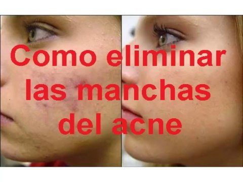COMO ELIMINAR LAS MANCHAS DEL ACNE