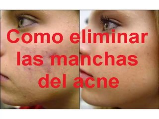 COMO ELIMINAR LAS MANCHAS DEL ACNE