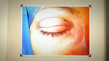 Eyelid Surgery