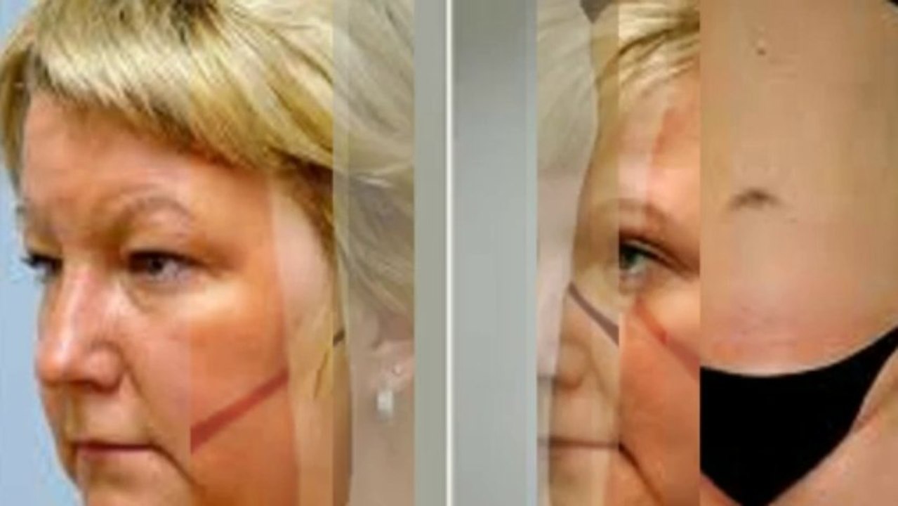 Liposuction