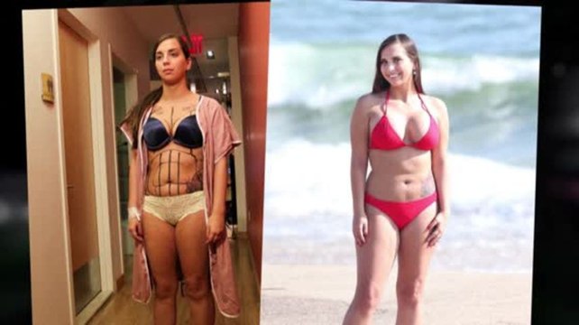 Sydney Leathers' Bikini Reveal After $40,000 Plastic Surgery