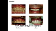 Dental Implants Calgary - Family Dentist Calgary-Teeth Whitening Calgary - Pediatric Dentist Calgary