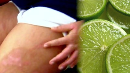 How Did Lime Juice Give These Girls Nasty Chemical Burns?