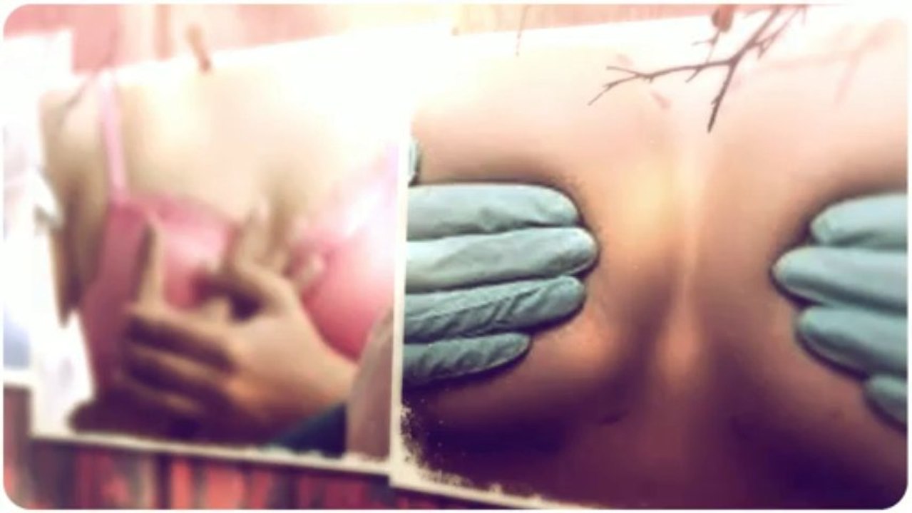 Breast Implants