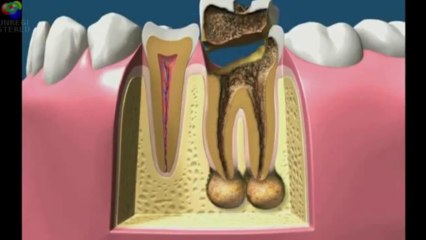 Evolución de la caries