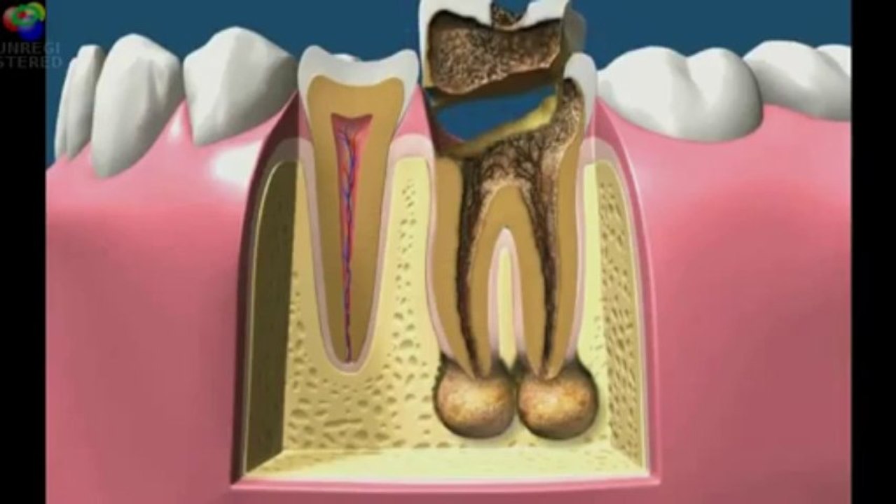 Evolución de la caries