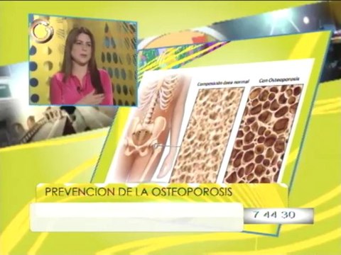 Conozca cómo prevenir la osteoporosis