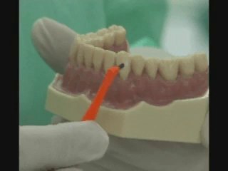 Cepillado interproximal o interdental