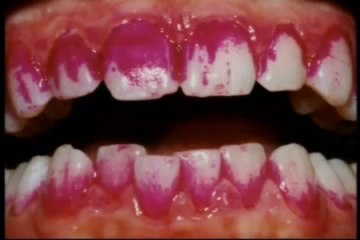 Pastillas reveladoras de placa